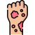 rash